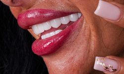 Hollywood Smile ile Mükemmel Gülüş İçin 5 Öneri
