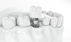 İmplant Tedavisi Nedir? Kimler İçin Uygundur?