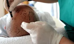 Kendini doktor olarak tanıttı, saç ekti: Hapis cezası aldı