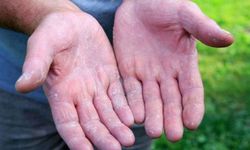 Çığır açan keşif: Egzamanın nedeni bulundu