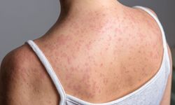 Kızamık Vakalarında Artış: İstanbul'da Hem Çocuklarda Hem Yetişkinlerde Görülüyor