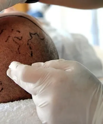 Kendini doktor olarak tanıttı, saç ekti: Hapis cezası aldı