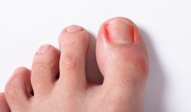 Tırnak Batması Nedir ve Neden Olur?