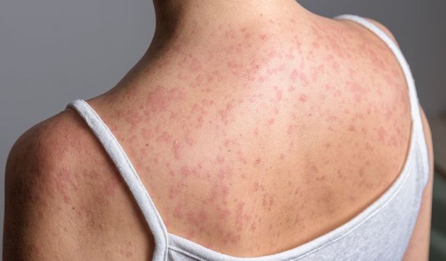 Kızamık Vakalarında Artış: İstanbul'da Hem Çocuklarda Hem Yetişkinlerde Görülüyor