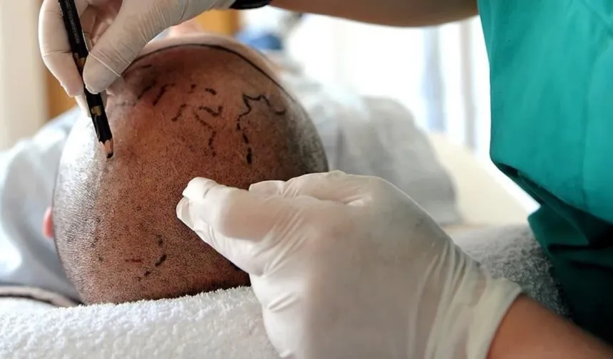 Saç ekimi sırasında fenalaşıp hayatını kaybetti